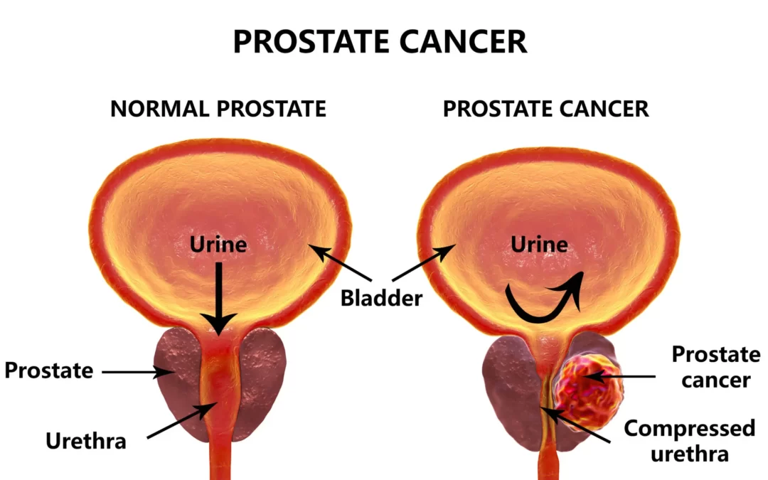 Warning signs for Prostate Cancer